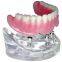 Full metal crown and bridge A Professional Outsourcing dental lab