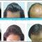 best hair regrowth oil for men/650nm diode laser hair regrowth restoration hair loss therapy