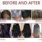 Best seller 2022 loss treatment hair regrowth led hair regrowth helmet scalp machine with hair analyzer