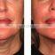 Eye Lines Removal Anti-wrinkle/skin Tightening Focused Ultrasound Hifu Beauty Machine 2000 Shots