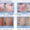 China Top Ten Selling Products Vascular Vein Removal / Varicose Veins Laser Treatment Machine