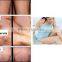 808nm diode laser device hair removal beauty equipmentl(JB-808)