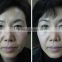 Waist Shaping Hifu Ultrasound Machine Hifu Face Lift Deep Wrinkle Removal And Skin Rejuvenation With 3 Hifu Cartridges