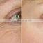 2017 Most effective microneedle skin tightenting fractional rf machine wrinkle removel with high quality