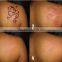 2016 tattoo removal nd yag laser beauty product for beauty skin care clinic