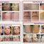 Hottest Painless Permanent Hair Removal Laser Machine Suplier for Beauty Spa