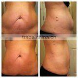 New Mdoel Tb-lipo Laser Body Slimming Fat Burning Device/best Selling TB-Lipo Laser Weight Loss Machine thumbnail-6