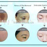 Hot Selling F12 Q-switched nd Yag Laser Skin Carbon Rejuvenation thumbnail-2
