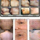 no Pain Permanent Hair Removal Diode Laser/high Power 12*20mm Big Diode Laser Hair Removal/best Price Dilas Hair Removal Machine thumbnail-6