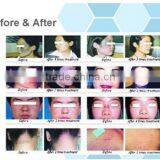 Eliminate Body Odor Professional Beauty Equipment Portable Co2 Fractional Face Lifting Laser/ Fractional Laser Co2/ Fractional Co2 Laser thumbnail-5