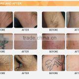 2017 Best Spa Skin Treatment Shr Ipl Laser Hair Removal Machine Price thumbnail-6