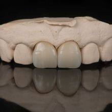 Digital-Crowns-Bridges Dental Laboratory in China thumbnail-3