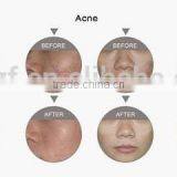 Acne Scar Removal Two Heads Of 0.1-2.6mm Acne Scar Removal CO2 Fractional Laser Machine thumbnail-5