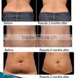 2017 Advanced Beijing Sincoheren Cellulite Freezing Cool Shaping Machine for Weight Loss thumbnail-2