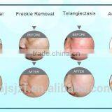 Pigmented Spot Removal RF Radio Frequency Breast Lifting Up IPL Beauty Machine Ipl-C thumbnail-4