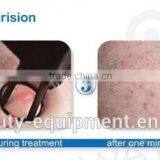 RF Pipe Fractional Co2 Carboxytherapy Laser Vaginal Tightening Machine Treat Telangiectasis thumbnail-4
