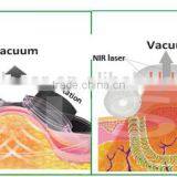 Rf Cavitation Machine 2016 New Arrival RF Vacuum Cavitation Rf Slimming Machine Ultrasonic Cavitation Slimming Machine Ultrasonic Liposuction Cavitation Slimming Machine thumbnail-3