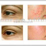 Acne Removal Device Fractional rf thumbnail-5