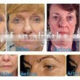 HIFU-C HIFU Wrinkle Removal Equipment thumbnail-4