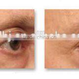 The Most Impressive Safe Beauty Therapy Radio Frequency For Home Use Portable Machine thumbnail-6