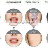 Portable Tattoo Removal Machine thumbnail-3