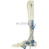 Конкурентоспособная цена. Ортопедический внешний фиксатор голеностопного сустава. Ортопедические хирургические импланты. Медицинские инструменты