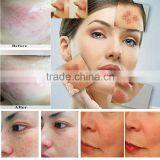 2016 e Light Hair Removal Wrinkles Removal Epilator Lady Facial Device thumbnail-6