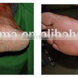 UVB Narrow Band (NB) PL-S 9W/01 311nm Lamps, Hand Held UVB Therapy Lamp thumbnail-2