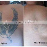 2016 Invention 10mm Big Spot Pigment Removal 1500mj Q Switched Alexandrite Laser Machine Telangiectasis Treatment thumbnail-5