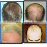 650nm Diode Laser PDT Led Laser Hair Growth For Hair Loss Treatment thumbnail-5