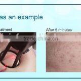 Hyperplastic Scar Removal, Co2 Fractional Laser thumbnail-2