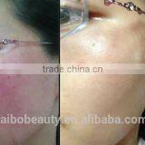 Distributor Low Price ! 980nm Spider Vein Removal Machine Vascular Remover 980 Varicose Vein Laser thumbnail-3