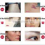 Best-selling Nd Yag Mongolian Spots Removal Laser Pigment Removal Machine Haemangioma Treatment thumbnail-6