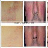 Professional Facial Vein Redness Removal Leg Spider Vein Removal Machine/ Salon and Clinic Use Red Vascular Vein Removal Machine thumbnail-6