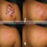 Pigmented Lesions Treatment 1320nm Carbon Powder Skin Whitening Tattoo Removal Laser Machine Q Switch Nd Yag Laser Tattoo Removal Machine thumbnail-4