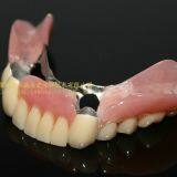 Dental Telescope Denture, Telesope Crown, Dental Prosthesis, Laboratoire Dentaire, Dentallabor, Laboratorio Dental, Dental Laboratory, Shenzhen LJ Dental Lab China thumbnail-3