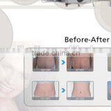 Lipolaser Slimming Machine thumbnail-2