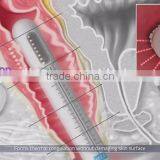 High Frequency  2017 Trending HIFU Vaginal Tightening Machine For Sale Back Tightening thumbnail-5