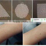 Vaginal Tightening Co2 Fractional Laser/fractional Co2 Laser Scar Removal/fractional Co2 thumbnail-5