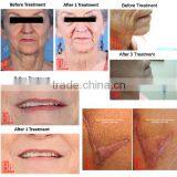 2015 Hottest Derma Pen/electric Microneedle Derma Pen Needle Cartridge thumbnail-5