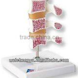 Cutaway Osteoporosis Model