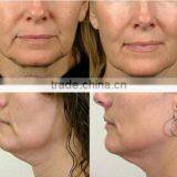 Q Switch Laser Tattoo Removal Good Market For Ipl Shr Elight Nd Yag Pore Removal Laser With Long Pulse 1064nm Naevus Of Ota Removal thumbnail-4