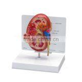 Pathological Medical Human Body Anatomy Model Kidney thumbnail-3