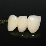 Dental Crown Zirconia PFZ, Dental Teeth, Dental Prosthesis, Laboratoire Dentaire, Dentallabor, Laboratorio Dental, Dental Laboratory, Shenzhen LJ Dental Lab China thumbnail-3