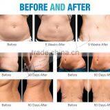 Portable 3 in 1 Cryotherapy Fat Freezing Machine Vacuum, Fat Freeze Cryotherapy Cooling Vacuum thumbnail-6