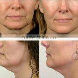 Intracel Fractional rf Microneedle Machine/fractional rf Skin Rejuvenation Beauty Equipment thumbnail-6