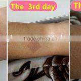 Vaginal Tightening Co2 Fractional Laser/fractional Co2 Laser Scar Removal/fractional Co2 thumbnail-6