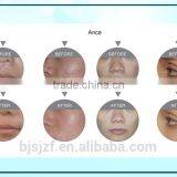 Carboxytherapy F5 Co2 RF/Glass Pipe Fractional Vagina Vascular Treatment Tightening Co2 Laser Equipment Anybeauty Original Manufacturer 10MHz thumbnail-6