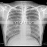 Medical Manufacturer Made in China Supplier for Hospital Dry Film Japan Film thumbnail-6