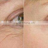 RF Equipment An-ti Wrinkle Machine With Micro Needle RF Fractional Needle RF thumbnail-6